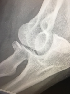 X-ray of broken radius and ulna.
