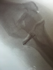 Screws in broken elbow.